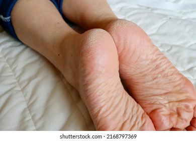 Cracked Heel. Skin Problems Caused By Dryness And Poor Circulation.