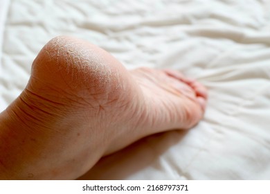 Cracked Heel. Skin Problems Caused By Dryness And Poor Circulation.