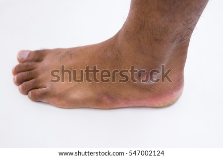 black skin on feet black skin on feet