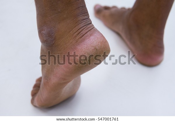 Cracked Heels Ankles Feet Black Skin 