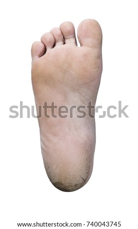 cracked heels of right foot isolate on white ,clipping path