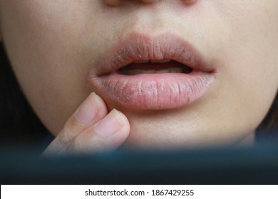 Cracked Lips Caused By Dry Skin And Lack Of Saliva : Dry Mouth Symptoms