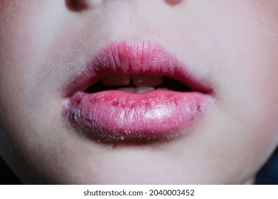 Cracked lips caused wound on the corner of the lips: dry skin problem with mouth disease, Angular cheilitis close up of chapped