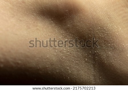 Cracked skin due to dryness with skin peeling on a womans ankle, textured detail shot. Rough dry damaged caucasian skin due to lack of skincare or moisture treatment creating a peeling effect