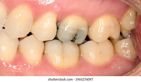 Cracked Tooth With Very Old Amalgam