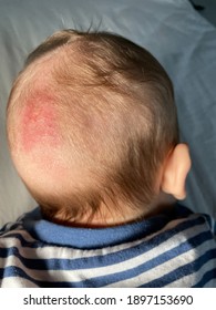 Cradle Cap Is A Harmless Skin Condition That's Common In Babies.