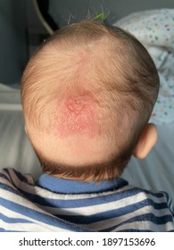 Cradle Cap Is A Harmless Skin Condition That's Common In Babies.