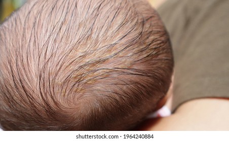 Cradle Cap On A Newborn Child Head Black Hair.