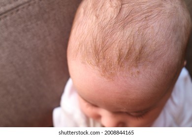 Cradle Cap (seborrheic Dermatitis) On The Head Of Babies