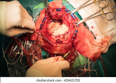 Craniotomy