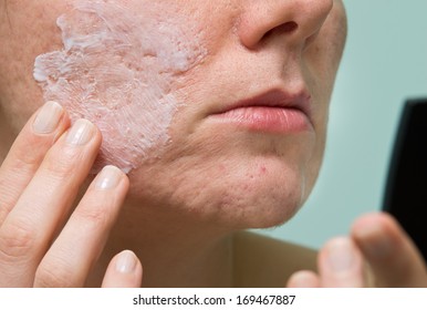 Cream Applying To Problematic Female Skin With Acne Scars