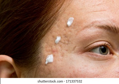 Cream Applying To Problematic Female Skin With Acne Scars