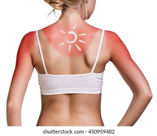 Cream On The Shoulder Of Woman With Sunburn