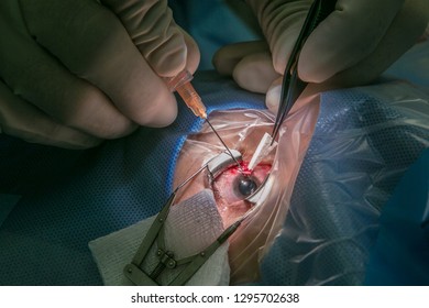 creating an inlet channel prior to the implantation of an anti-glaucoma implant Express - Shutterstock ID 1295702638