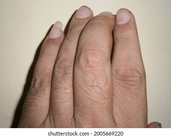 Crooked Middle Finger Due Gout Stock Photo 2005669220 | Shutterstock