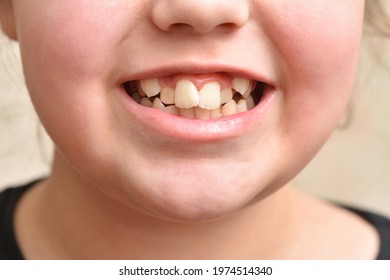 Crooked teeth in a child girl, close up