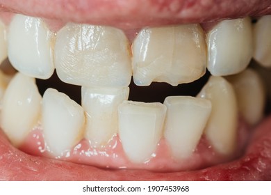 Crooked Teeth. Extended Tooth With A Chip