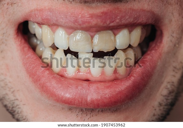 Crooked teeth. Extended\
tooth with a chip