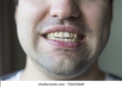 Crooked Teeth In A Man