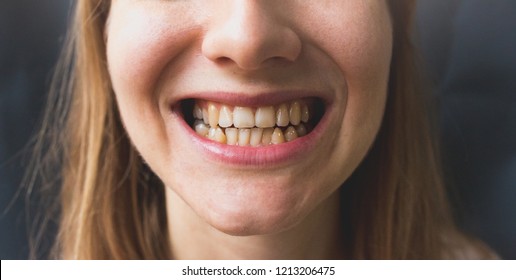 Crooked Teeth In The Woman's Mouth. Dental Decay And Bad Smile. Dentist Treatment Concept.