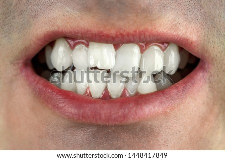 crooked teeth, wrong bite, close-up