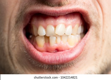 Ugly Teeth Images, Stock Photos & Vectors | Shutterstock