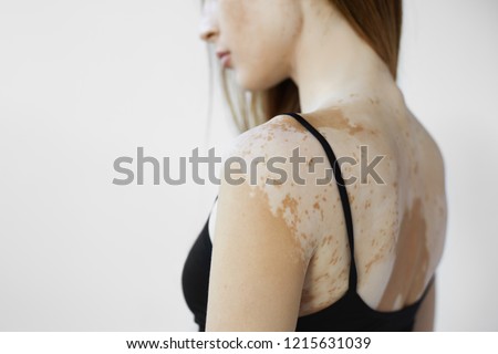 Cropped back view of beautiful young European woman with skin condition that causes loss of melanin posing indoors. Slender slim female model in black tank top suffering from vitiligo disorder
