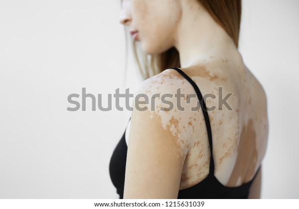 Cropped back view of beautiful young European\
woman with skin condition that causes loss of melanin posing\
indoors. Slender slim female model in black tank top suffering from\
vitiligo disorder