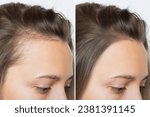 Cropped before and after head shot of a young woman with bald patches on her forehead and temples. Baldness. Close-up, side view. Hair care and treatment concept. Hair loss, hair extensions, alopecia.