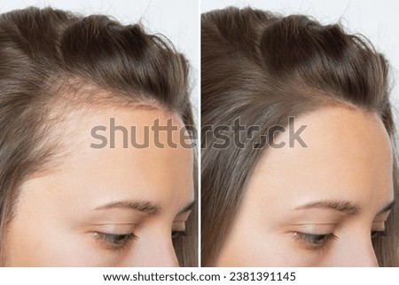 Cropped before and after head shot of a young woman with bald patches on her forehead and temples. Baldness. Close-up, side view. Hair care and treatment concept. Hair loss, hair extensions, alopecia. Stock fotó © 