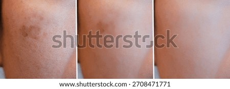 cropped Image before and after spot melasma pigmentation treatment on skin face asian woman compare in 3 development periods. Skincare and beauty concept	