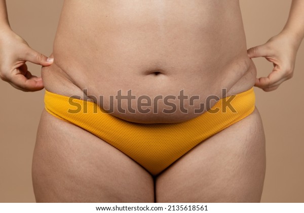 Cropped image of close-up overweight woman\
belly, holding hips, big excessive stomach with navel in yellow\
pants. Dangling down stomach, folds, big size. Drag away of\
abdomen. Go on diet,\
liposuction