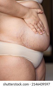 Cropped Image Fat Overweight Woman Holding Tummy In Arms With Stretch Marks, Striae. Folds Hanging. Show Off The Belly After Birth. Loosing Skin Turgor, Collagen, Dehydrated. Close Up, Side View