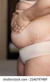 Cropped Image Fat Overweight Woman Holding Tummy In Arms, With Stretch Marks, Striae. Fast Gain Weight. Body After Childbirth. Loosing Skin Turgor, Fibrous Collagen, Dehydrated. Close Up, Side View