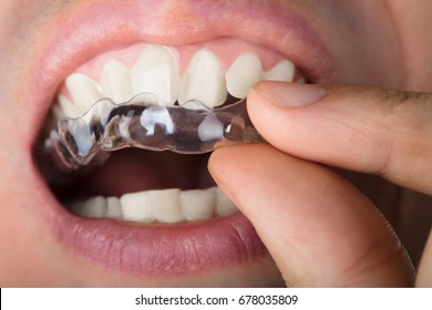 Cropped Image Of Man Adjusting Transparent Aligners In Teeth
