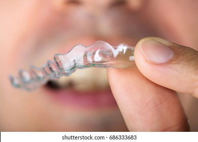 Cropped image of man holding transparent teeth aligners - Shutterstock ID 686333683