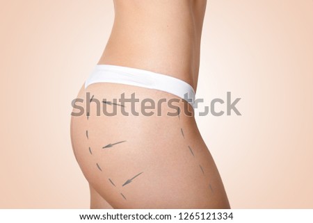 Cropped image of slim woman wears white pants, has marked arrows on hip, prepares for cellulite removal or plastic surgery, isolated over beige background. Slimming, liposuction, fat loosing concept