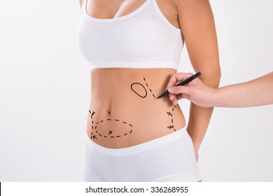 Cropped image of surgeon preparing woman for liposuction surgery over white background