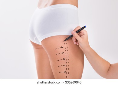 Cropped Image Of Surgeon Preparing Woman For Liposuction Surgery On Thigh Over White Background