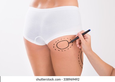 Cropped Image Of Surgeon Preparing Woman For Liposuction Surgery On Thigh Over White Background