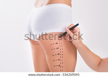 Cropped image of surgeon preparing woman for liposuction surgery on thigh over white background
