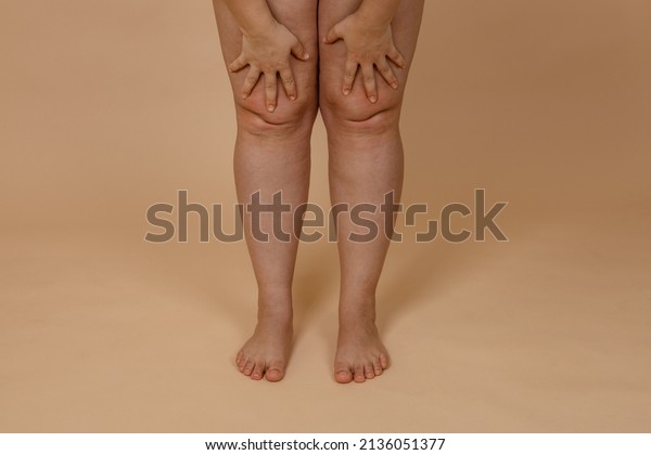 Cropped photo of woman bare naked legs, pinching fat\
on knees. Clipping fat folds. Removal of fat knees, liposuction of\
edematous skin. Varicose vein, dehydrated thick skin. Body care.\
Fat loss