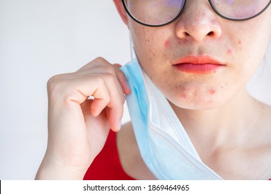 Cropped Shot Of Acne Inflamed Occur On Woman Face After Wearing Mask For Long Time During Covid-19 Pandemic. Wearing Mask For Prolonged Periods Can Damage The Skin.