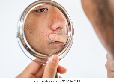 Cropped Shot Of Asian Man Saw The Problem Of Pimple Or Acne On His Face By A Mini Mirror. Conceptual Shot Of Acne And Problem Skin On Male Face.