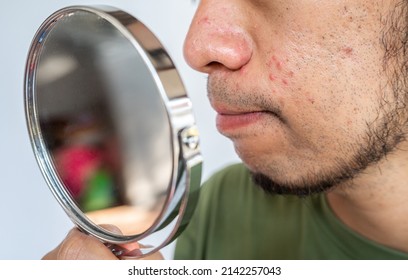 Cropped Shot Of Asian Man Saw The Problem Of Pimple Or Acne On His Face By A Mini Mirror. Conceptual Shot Of Acne And Problem Skin On Male Face.