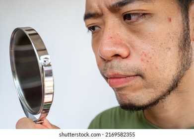 Cropped Shot Of Asian Man Saw The Problem Of Pimple Or Acne On His Face By A Mini Mirror. Conceptual Shot Of Acne And Problem Skin On Male Face.