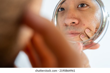 Cropped Shot Of Asian Man Saw The Problem Of Pimple Or Acne On His Face By A Mini Mirror. Conceptual Shot Of Acne And Problem Skin On Male Face.