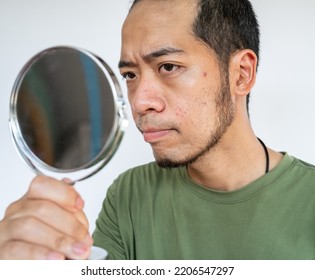 Cropped Shot Of Asian Man Saw The Problem Of Pimple Or Acne On His Face By A Mini Mirror. Conceptual Shot Of Acne And Problem Skin On Male Face.