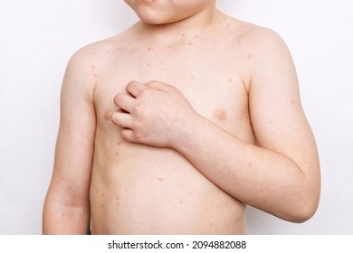 Cropped Shot Of A Child With A Red Rash On His Body Scratching The Skin Isolated On A White Background. Chickenpox, Measles, Allergies, Dermatitis, Herpes, Virus