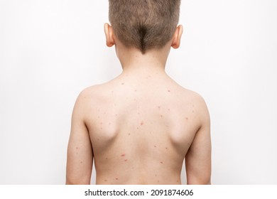 A Cropped Shot Of A Child Standing With His Back With A Red Rash On His Body Isolated On A White Background. Chickenpox, Measles, Allergies, Dermatitis, Herpes, Virus. Medical Concept